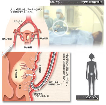 子宮 筋腫